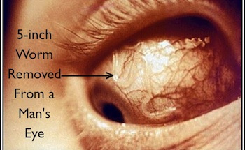 5-inch Worm Removed From a Man’s Eye