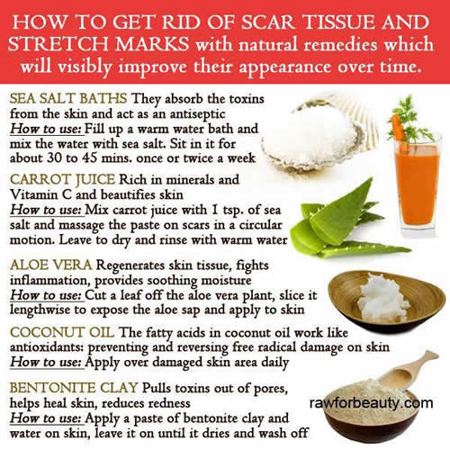 get rid of ‪ ‎scar‬ tissue and ‪ stretch‬ marks ,home remedy
