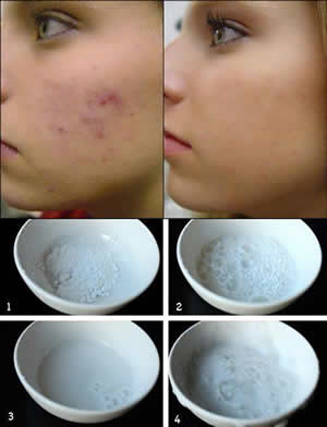  natural scar remover,home remedy