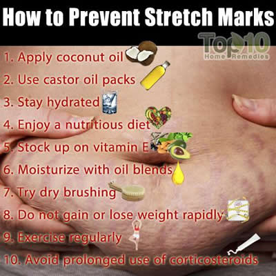 How to prevent stretch marks 