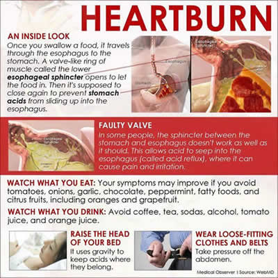 Remedies for Heartburn 