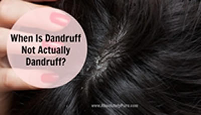 How to get Ride of Dandruff,remedies for dandruff 