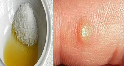 home remedy for wart