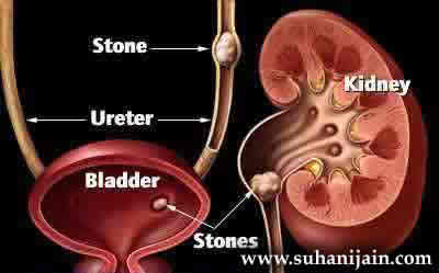 Herbs for Treating Kidney Stones!!